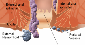 types of hemorrhoids